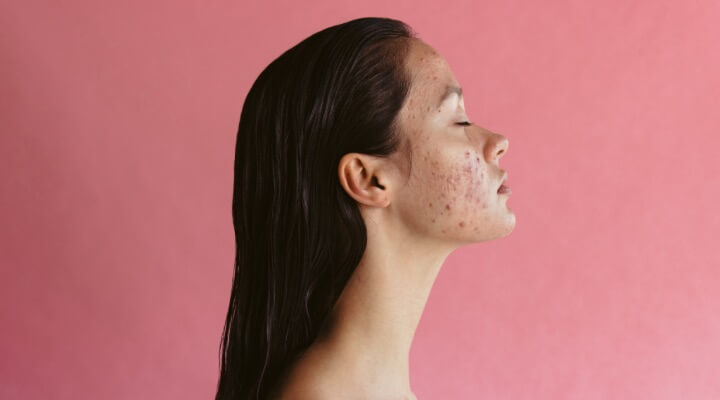 woman with acne