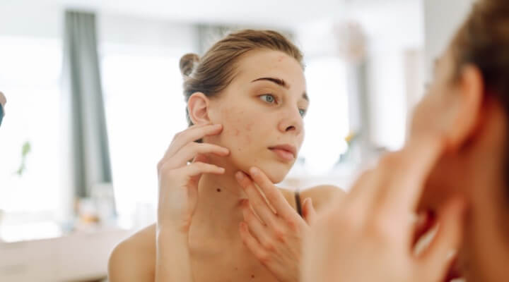 woman looking in mirror at acne